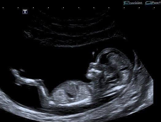 Ultraschall baby